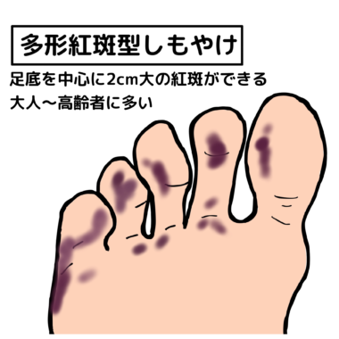 凍瘡(しもやけ) – 西三河の皮膚科・美容皮膚科|あおい皮フ科クリニック|肌・美容のお悩みに