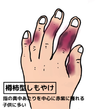凍瘡(しもやけ) – 西三河の皮膚科・美容皮膚科|あおい皮フ科クリニック|肌・美容のお悩みに
