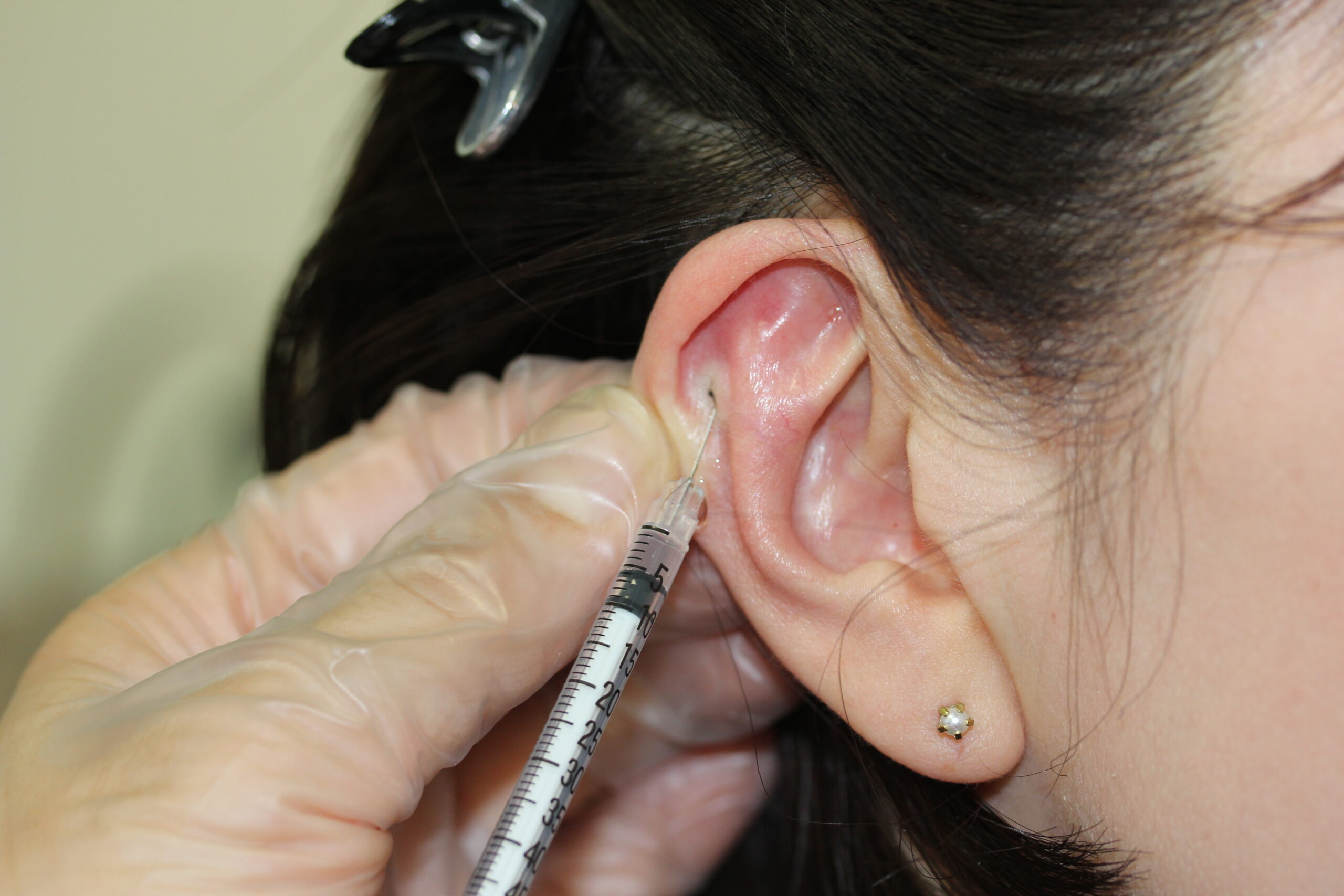 耳ピアス治療の流れ2