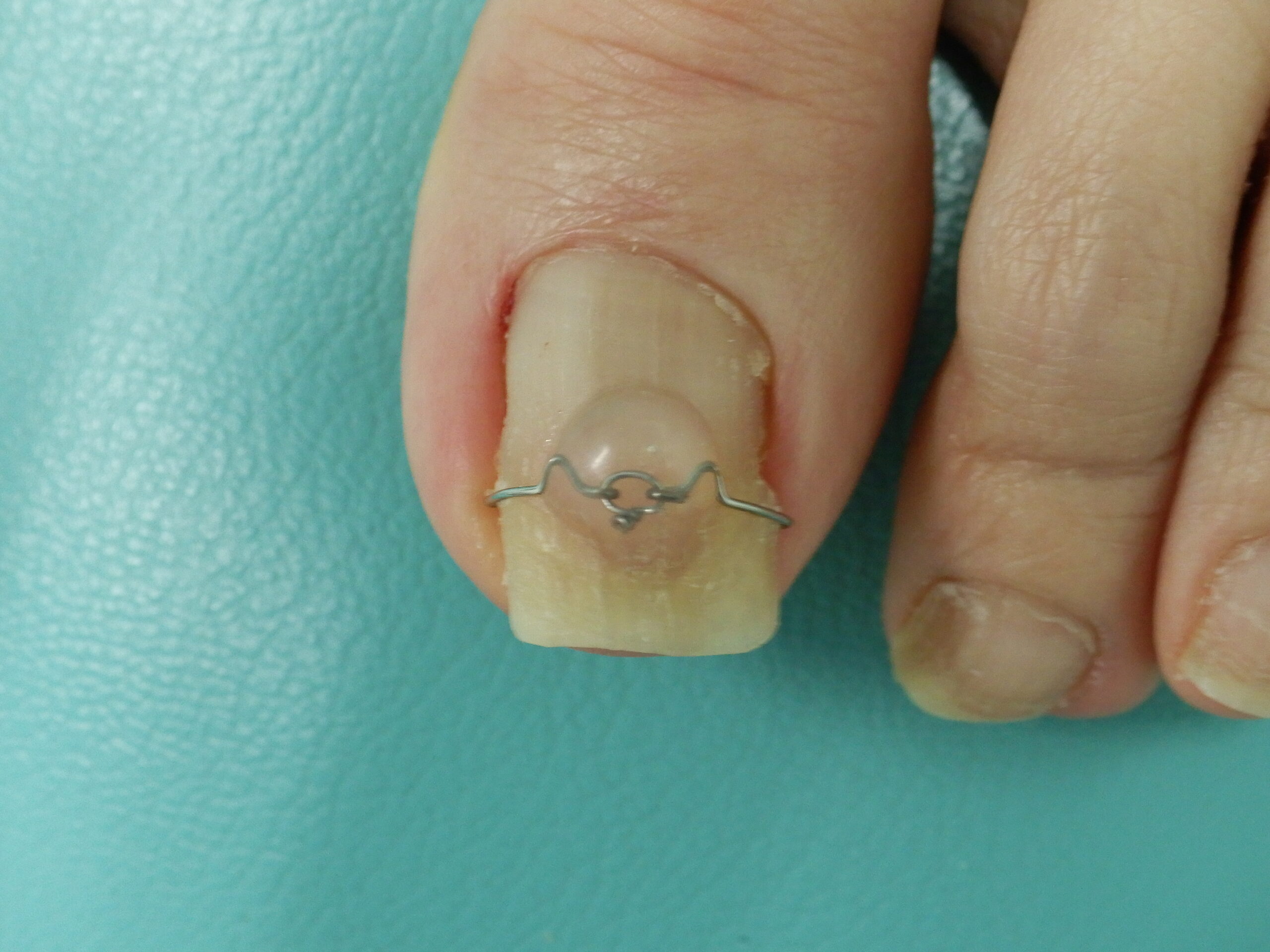 巻き爪・陥入爪 – 西三河の皮膚科・美容皮膚科｜あおい皮フ科クリニック｜肌・美容のお悩みに