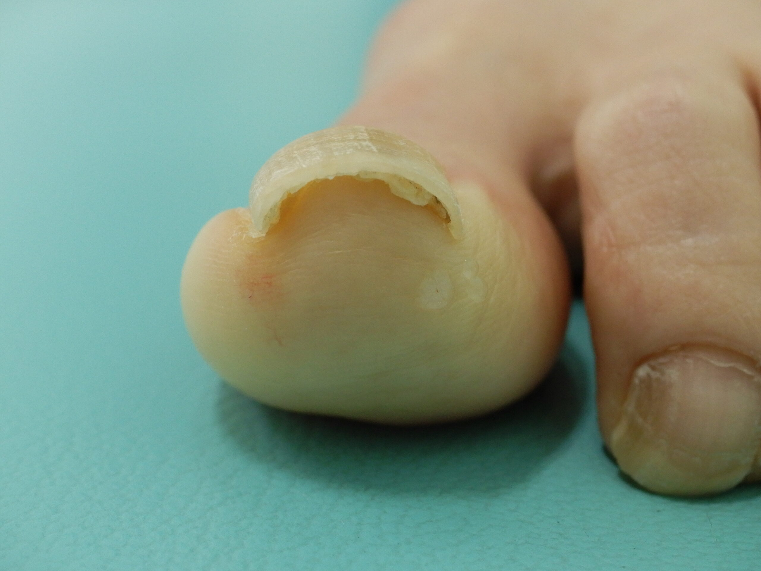 巻き爪・陥入爪 – 西三河の皮膚科・美容皮膚科｜あおい皮フ科クリニック｜肌・美容のお悩みに