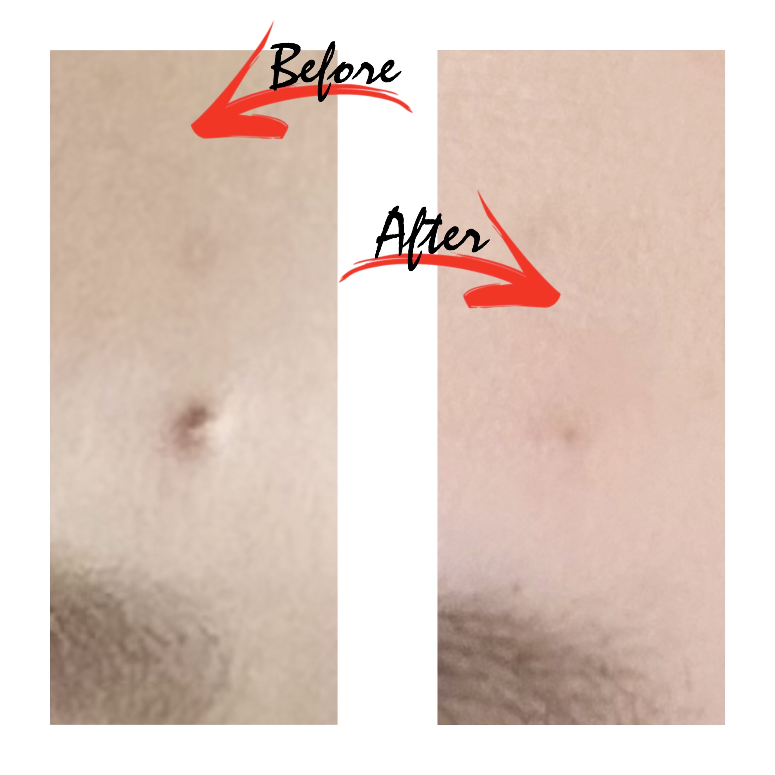 実体験！黒子除去とゼオスキンのトナーが最高だった話👂🏻